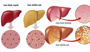 gan nhiễm mỡ lây qua đường nào