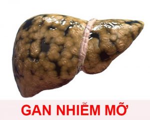 bệnh gan nhiễm mỡ có nguy hiểm không?