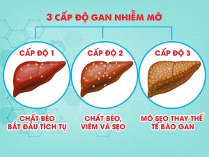 các cấp độ bệnh gan nhiễm mỡ