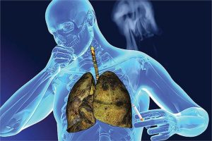 Hút thuốc lá là nguyên nhân chính dẫn đến ung thư phổi