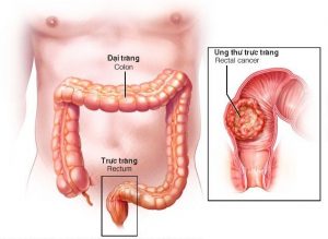 ung thư đại tràng giai đoạn 1