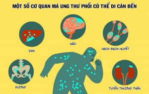 Di căn ung thư phổi đến các bộ phận khác