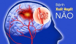 Tai biến - xuất huyết não