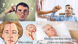 Dấu hiệu của bệnh tai biến