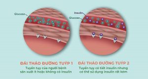 Đái tháo đường tuýp 1 và đái tháo đường tuýp 2