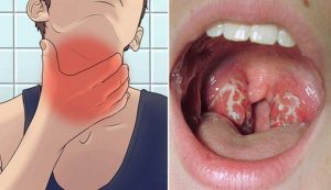 Bệnh bạch hầu là gì?