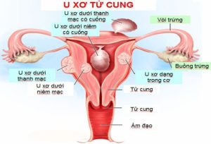Bệnh u xơ cổ tử cung ở phụ nữ