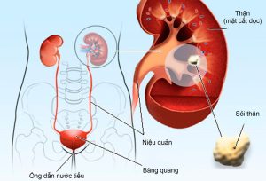 Qúa trình hình thành sỏi thận