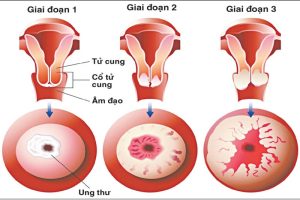 Các giai đoạn ung thư cổ tử cung