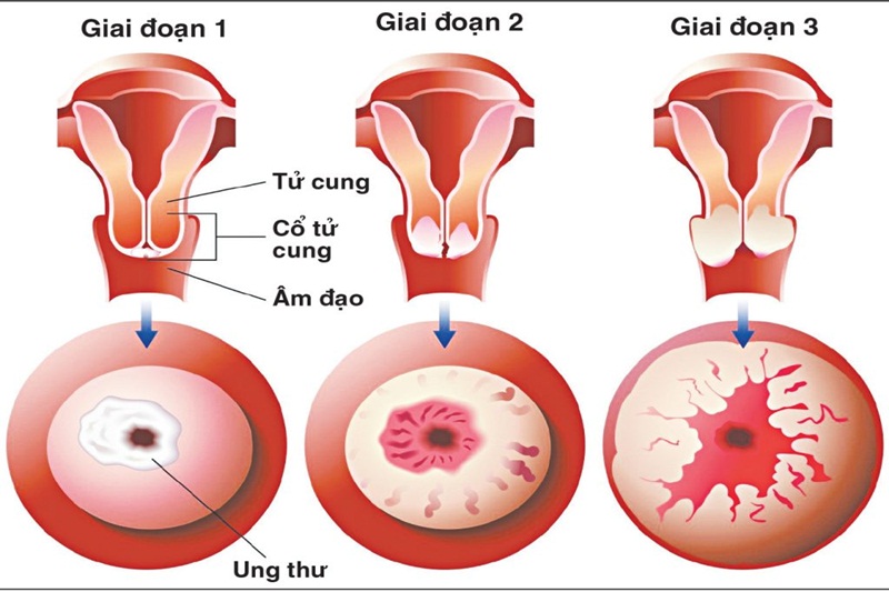Các giai đoạn ung thư cổ tử cung