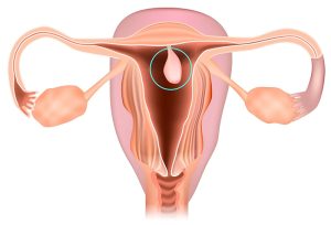 Polyp cổ tử cung là gì?