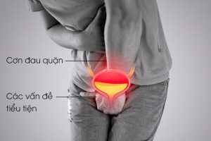 Triệu chứng của sỏi thận