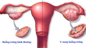 U nang buồng trứng ở phụ nữ
