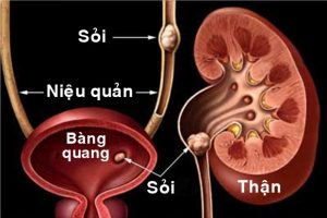 Nguyên nhân bị sỏi thận