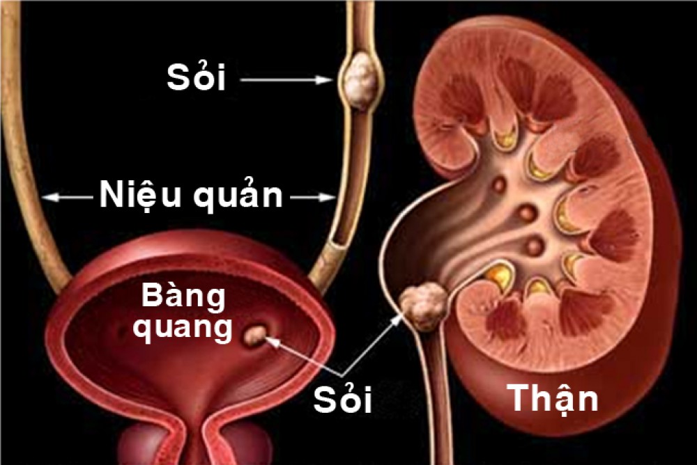 Nguyên nhân bị sỏi thận