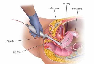 Cách điều trị ung thư cổ tử cung