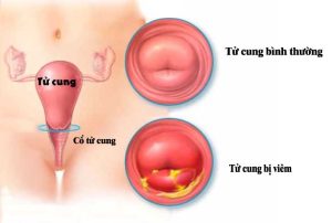 Viêm cổ tử cung là gì?