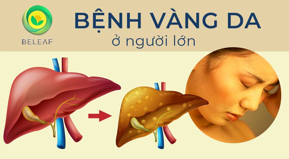bệnh vàng da ở người lớn