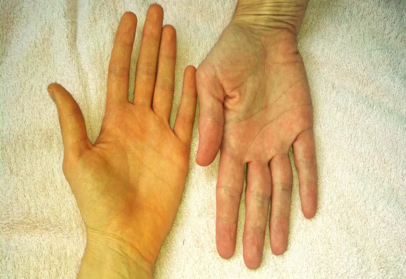 bệnh vàng da ở người lớn